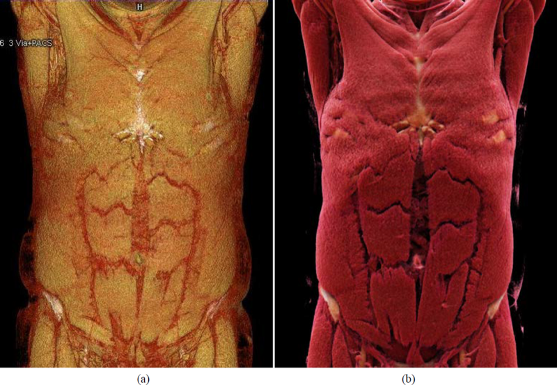 Two renderings of one whole-body CT scan side by side: a classic volume rendering and a cinematic rendering with realistic lighting.